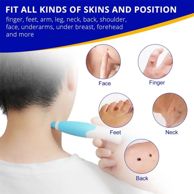 Painless Auto Skin Tag Mole Wart
