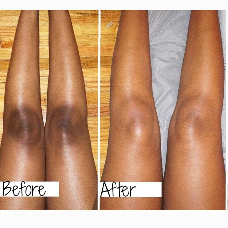 Anti Acanthosis Nigricans Whitening Cream Remove Melanin Armpit