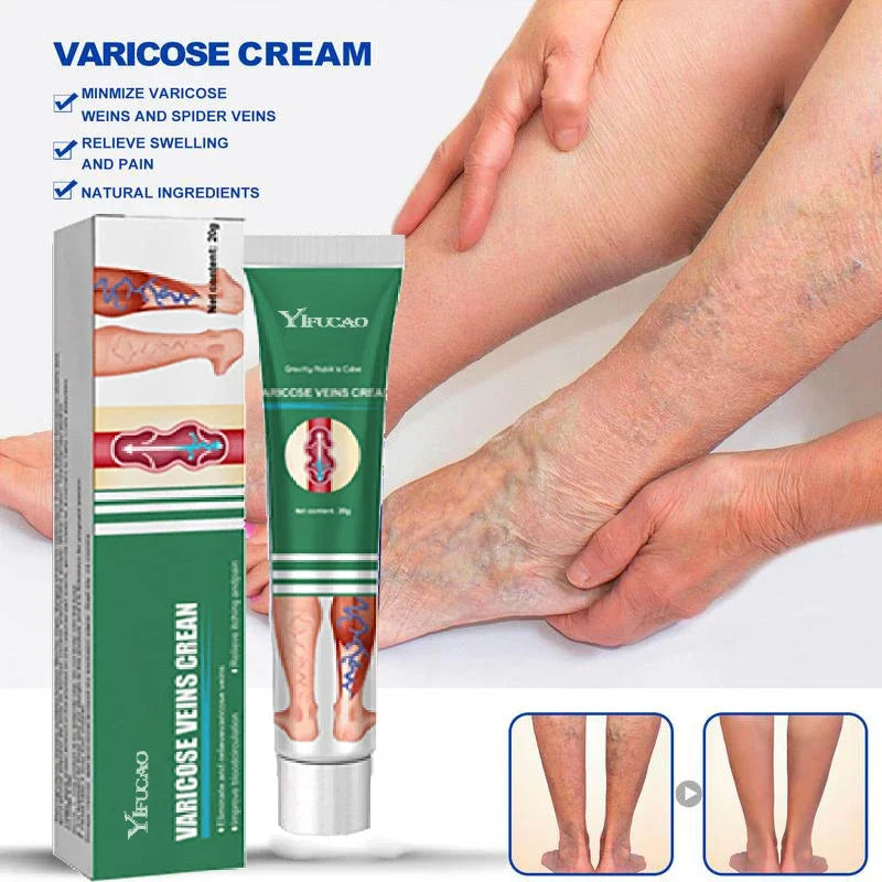Varicose Vein Treatments Cream Effective Relieve Legs Dilated