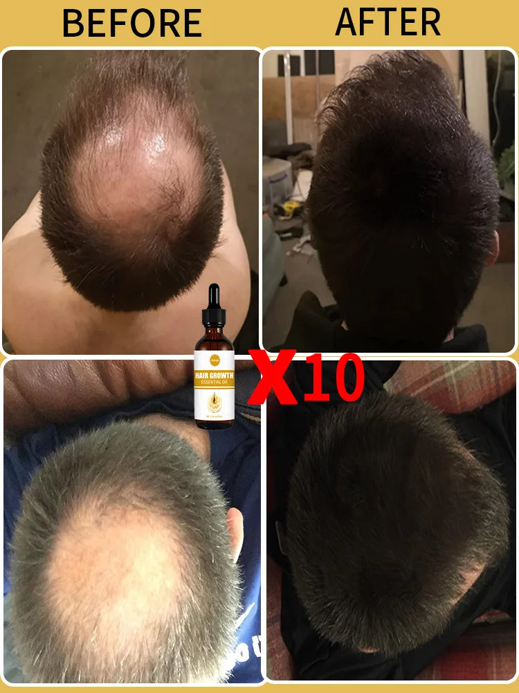 Hair Growth Oil Baldness For Men Treatment