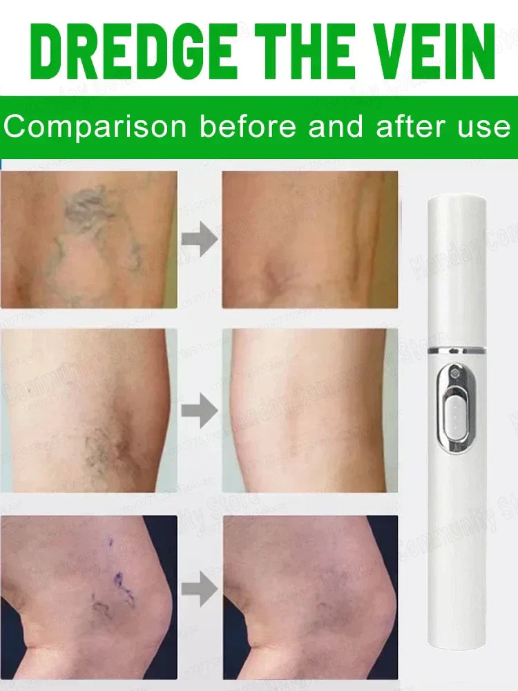 Powerful Laser Therapy For Moderate Varicose Veins, Relieve