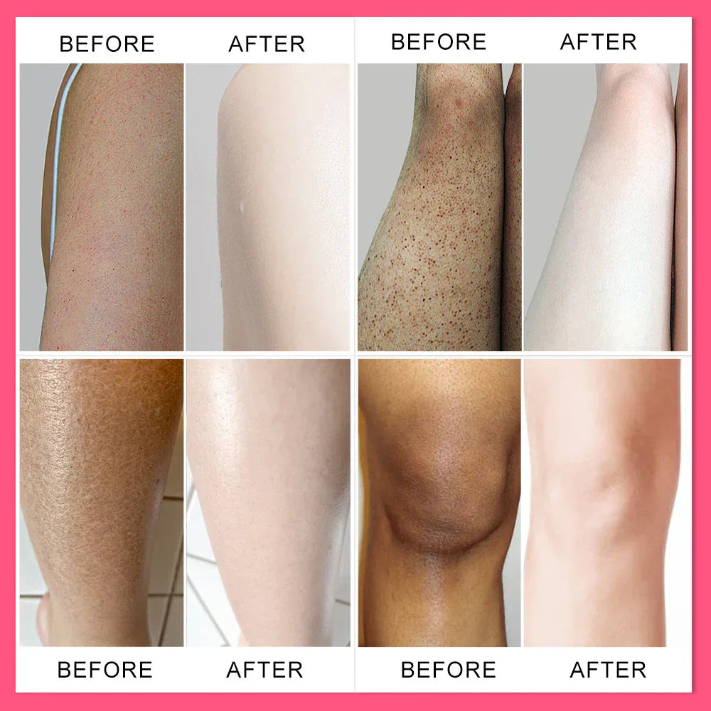 Joypretty Body Cream Chicken Skin Removal Treatment Pore