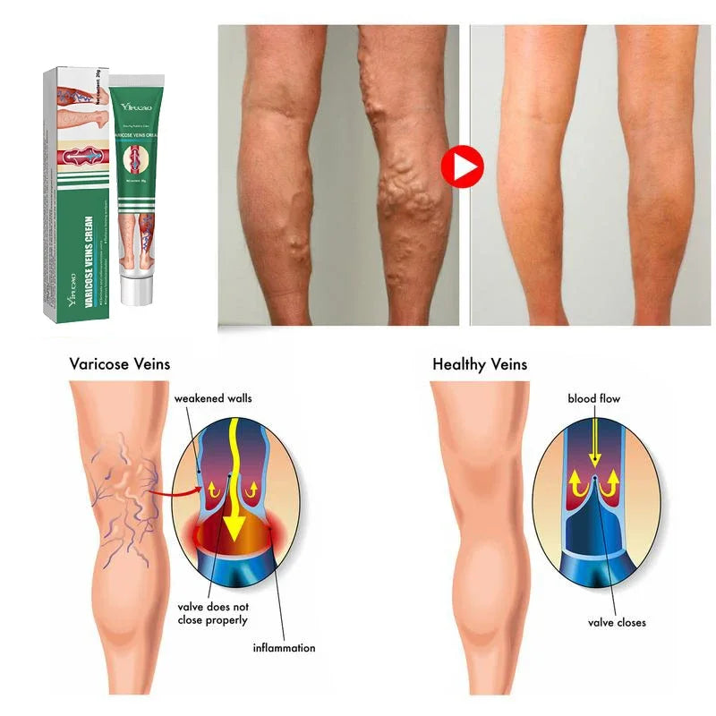 Varicose Vein Treatments Cream Effective Relieve Legs Dilated