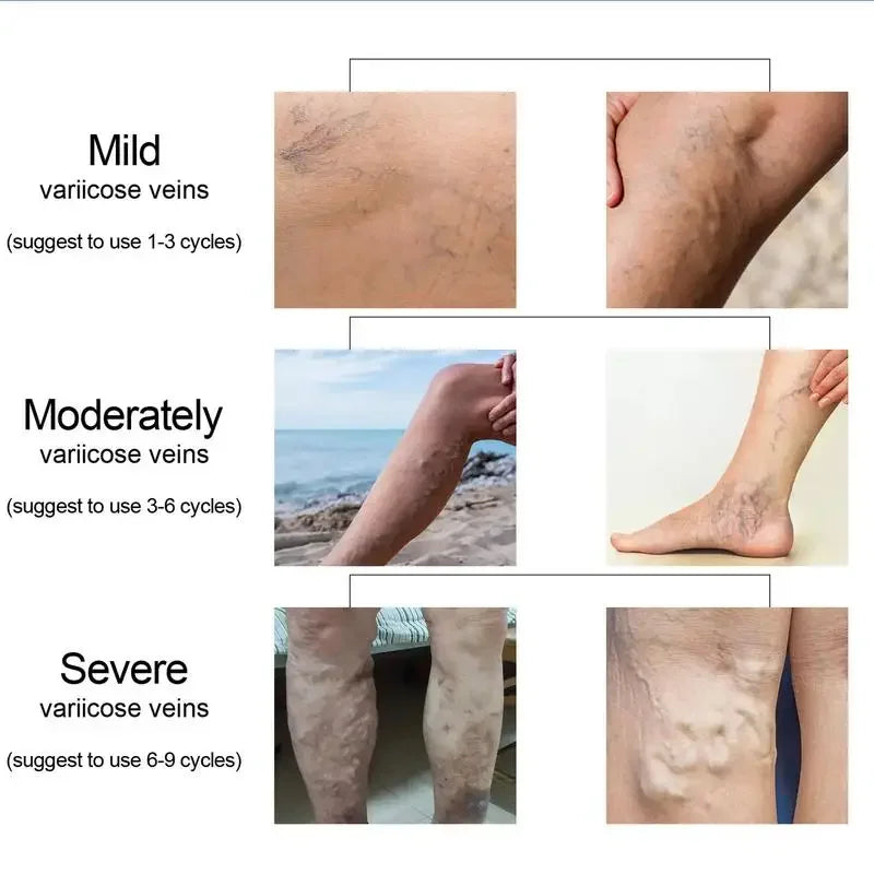 Varicose Vein Treatments Cream Effective Relieve Legs Dilated