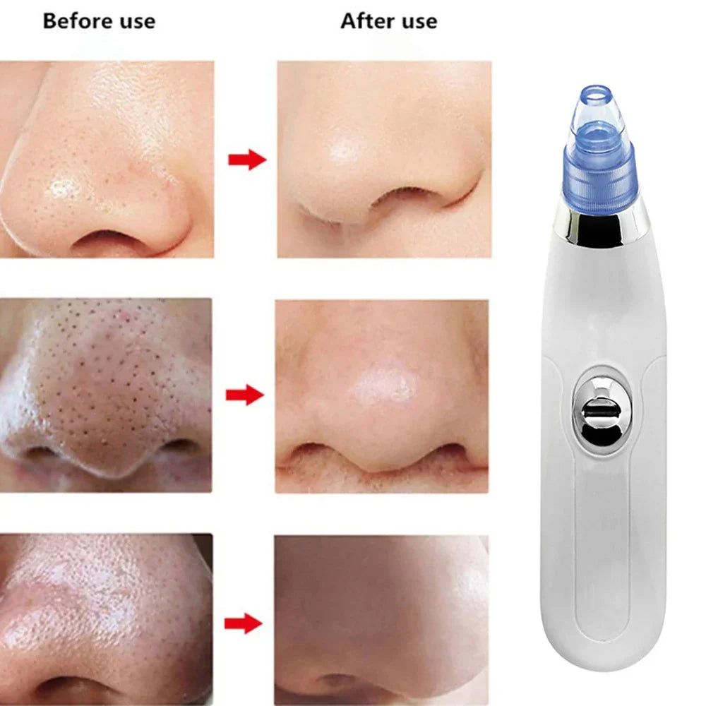 Electric Acne Remover Facial Cleaner Nose Blackhead Remover