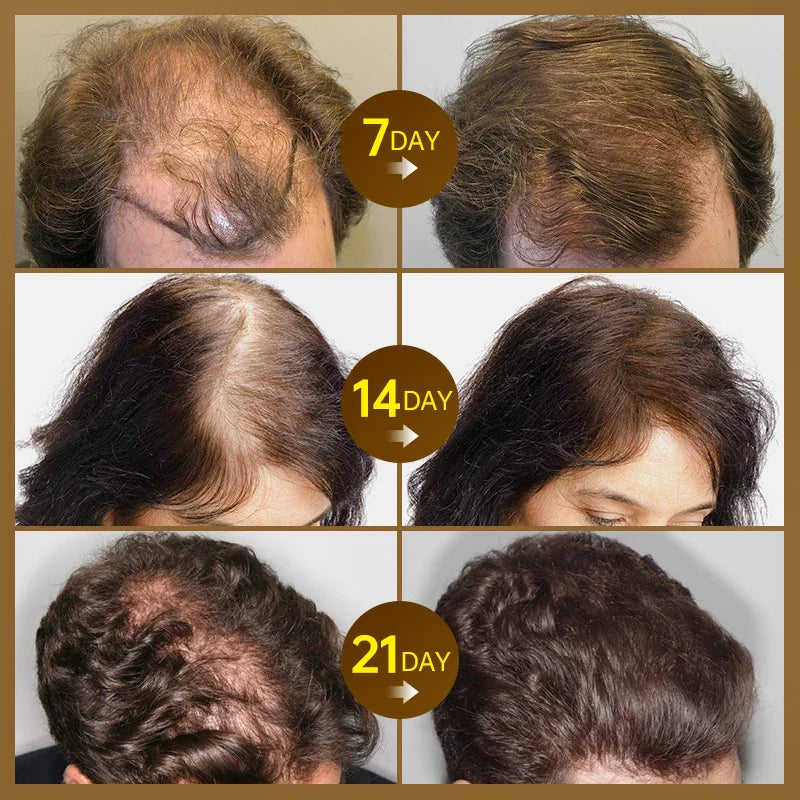 Purc Fast Hair Growth For Men Women Anti