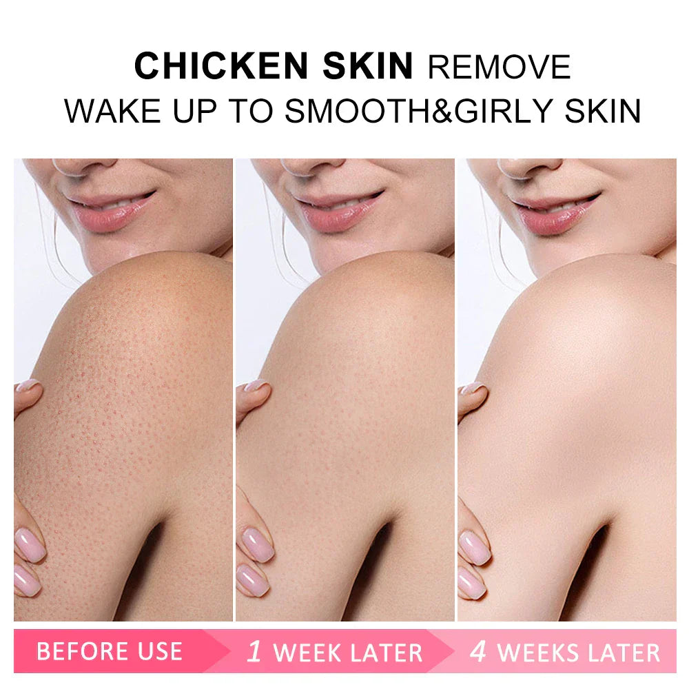 Joypretty Body Cream Chicken Skin Removal Treatment Pore