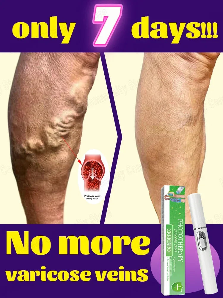 Powerful Laser Therapy For Moderate Varicose Veins, Relieve