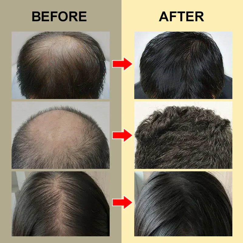 Purc Hair Growth For Men Women Products Ginger