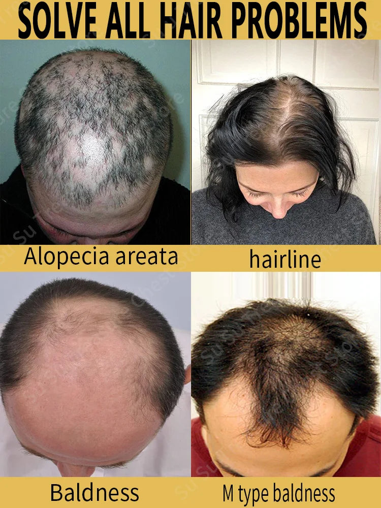 Hair Growth Oil Baldness For Men Treatment