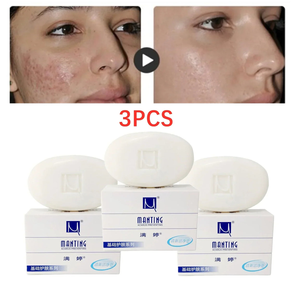 Manting Mites Acarus Acari Removing Body Face