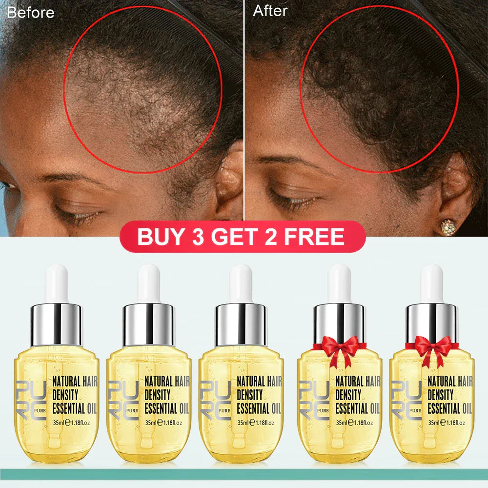 Purc Hair Growth Products For Men Women Ginger