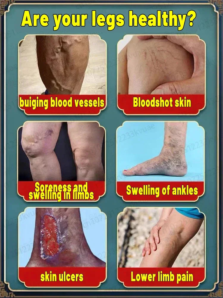 Powerful Laser Therapy For Moderate Varicose Veins, Relieve