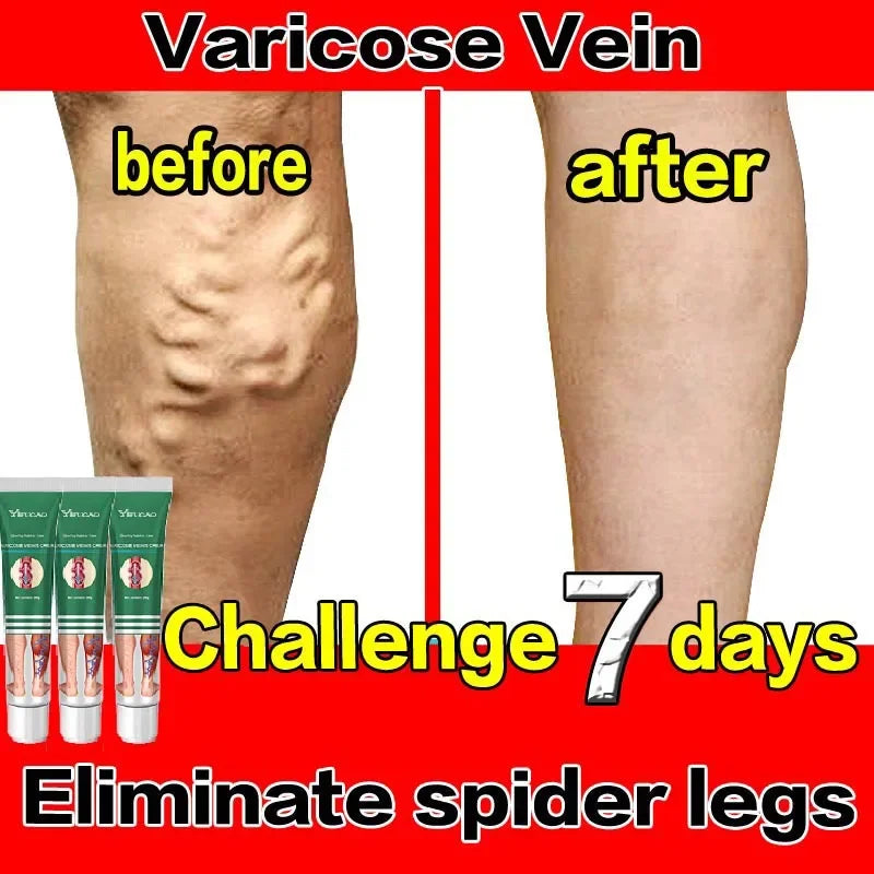 Varicose Vein Treatments Cream Effective Relieve Legs Dilated