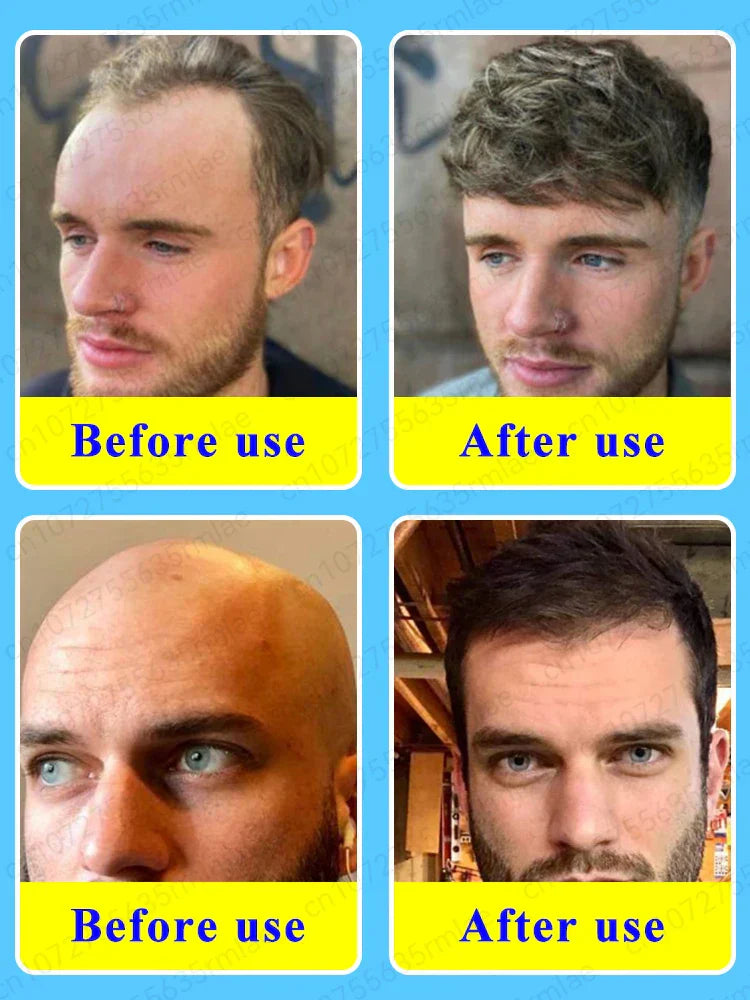 Hair Growth Oil,Effective Baldness Repair, Hereditary Hair Loss,