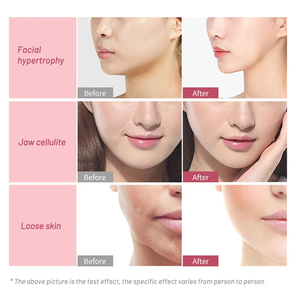 Ems Face Lifting Roller Rf Double Chin V