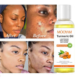 Turmeric Oil Face Whitening Lightening Acne Dark Patches