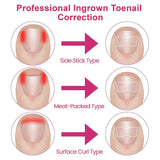 Ingrown Toenail Corrector Patches Nail Correction Care