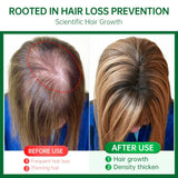 Purc Rosemary Oil Hair Growth For Men Women