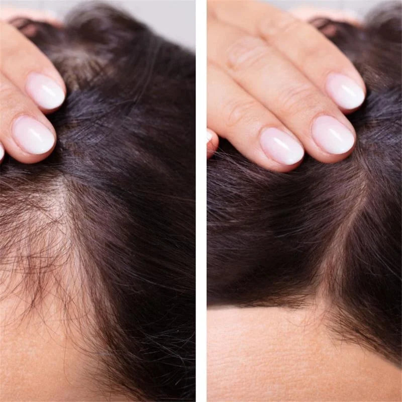 Ginger Hair Growth Product Anti-Loss Hair Regrowth Serum