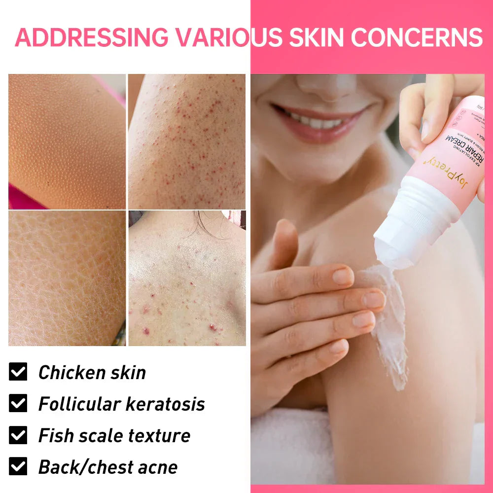 Joypretty Body Cream Chicken Skin Removal Treatment Pore