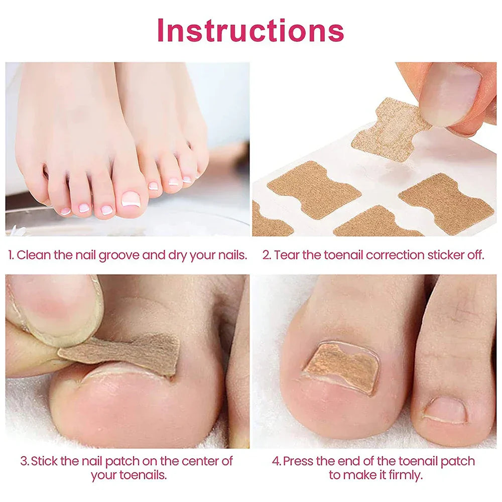 Ingrown Toenail Corrector Patches Nail Correction Care